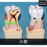 INPHIC-牙醫患溝通醫學模型醫療實驗道具蛀牙模型牙齒病綜合病理模型牙齒解剖剖面模型-小款